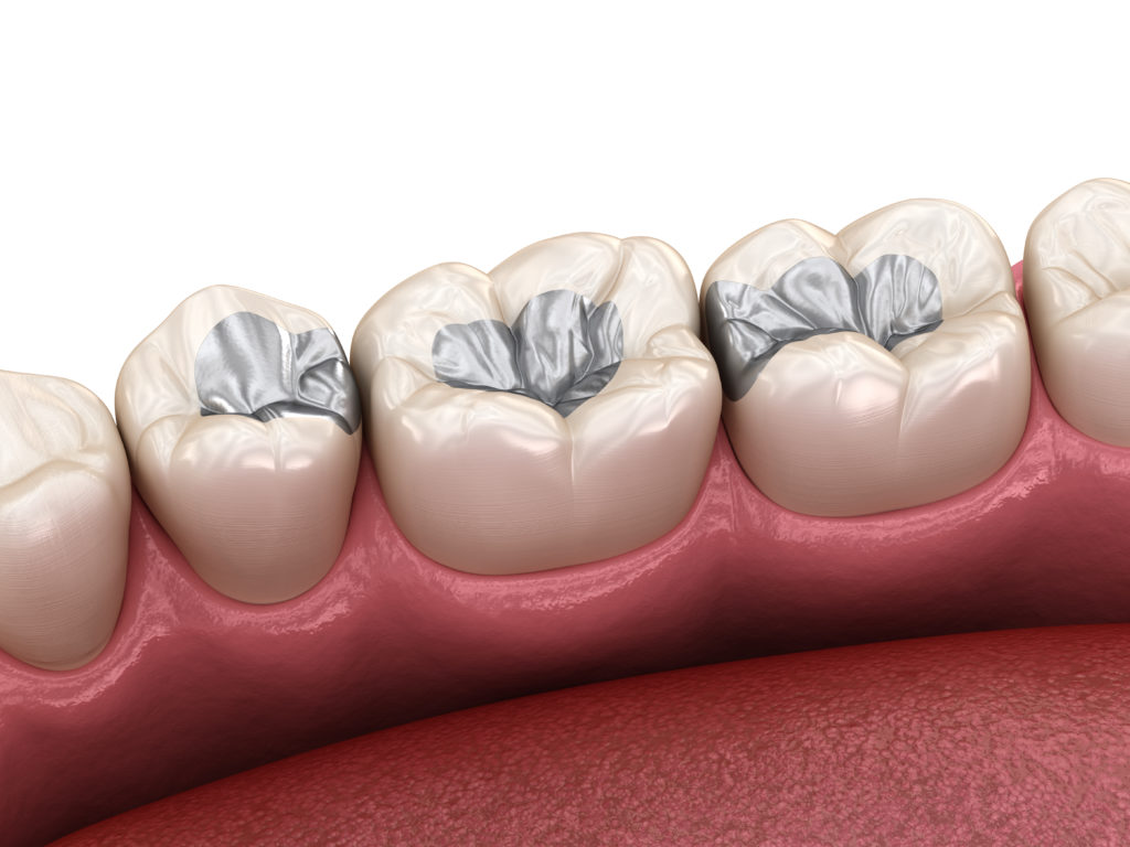 5 Types of Dental Fillings