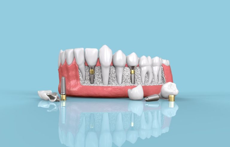 5 tipos de implantes dentales