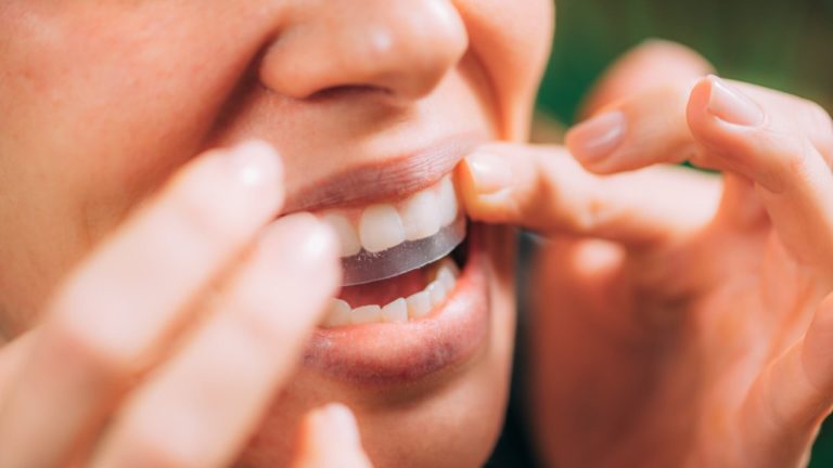 Do Whitening Strips Work?