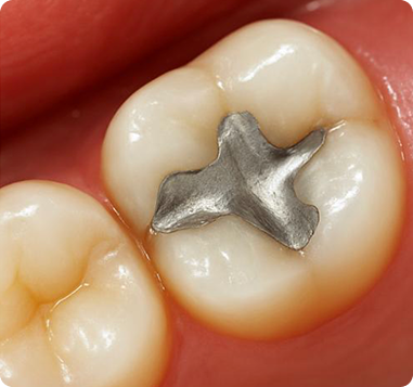 Amalgam Fillings