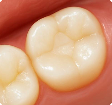 Composite Fillings