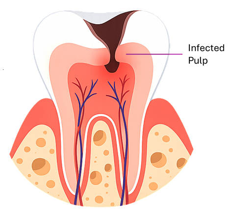 Infected Pulp