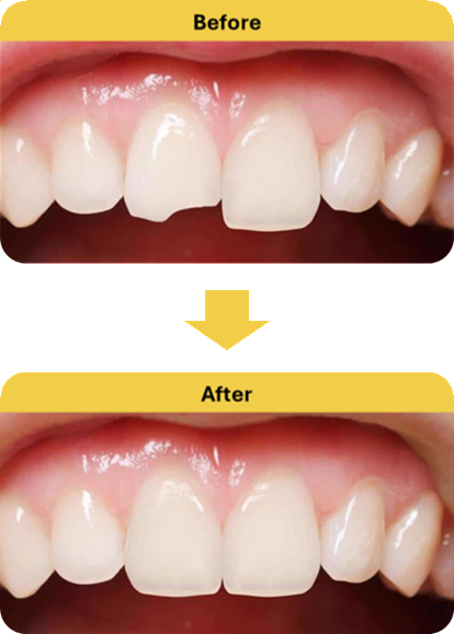 Fixing Chipped and Worn Teeth Before and After