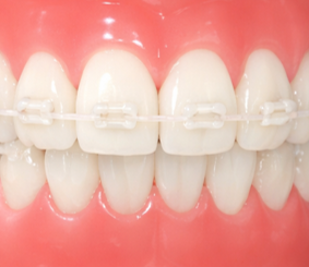 Braces Clear Ceramic