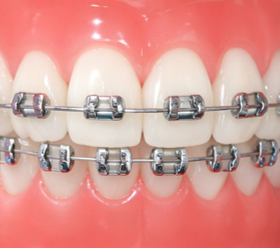 Braces Self Ligating