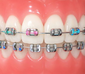Braces Traditional