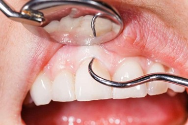 Exam Professional Teeth Cleaning