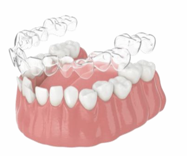 invisalign how it works step 2