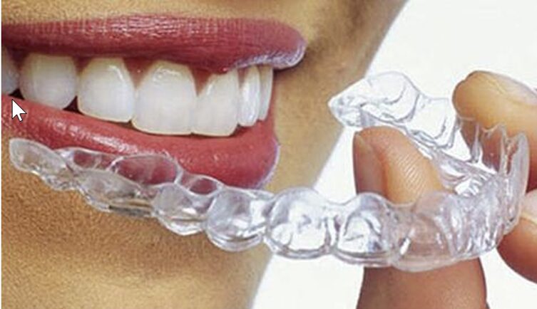 Invisalign what are invisalign aligners