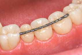 Fixed Retainers