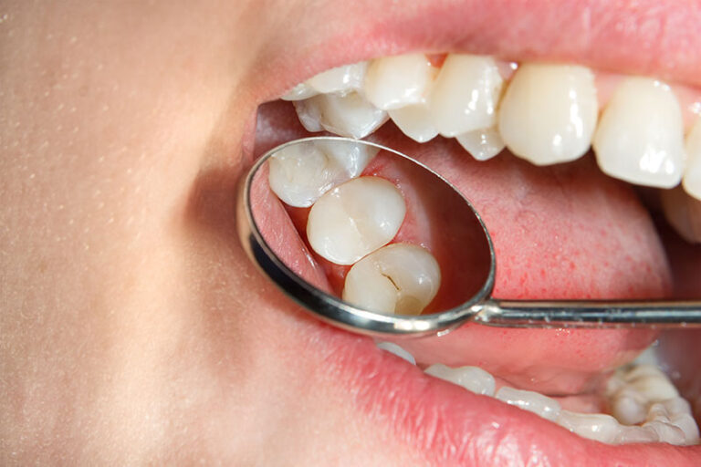 Dental Sealant
