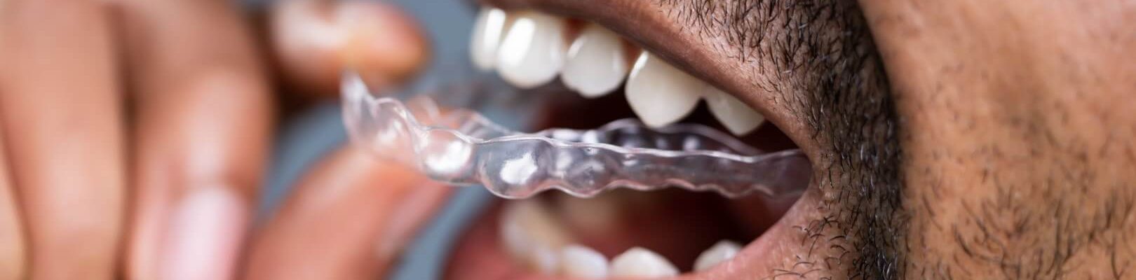 3M-Clarity-Aligners-minified