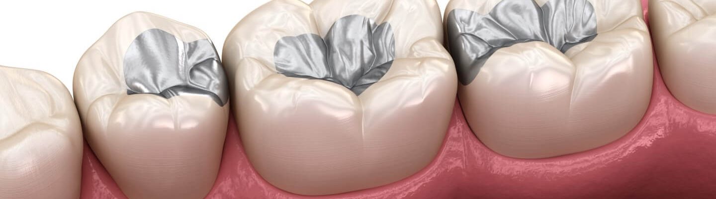 5-types-of-dental-fillings-scaled-minified
