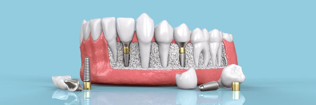 5 Types of Dental Implants