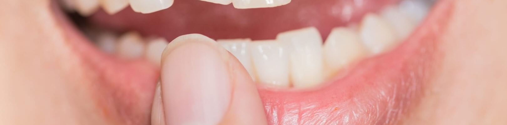 how-to-fix-a-cracked-tooth-scaled-minified
