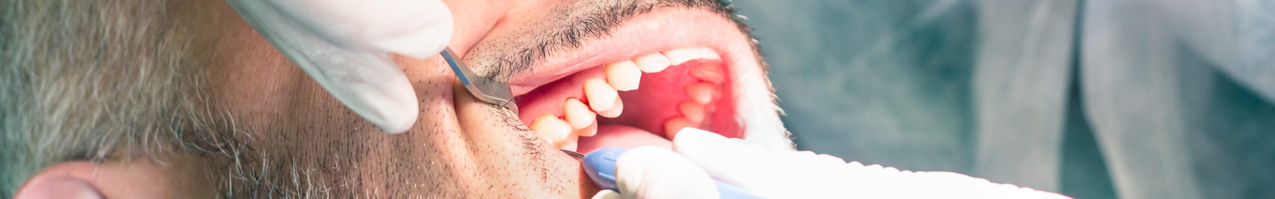 What Causes Plaque Buildup on Teeth?