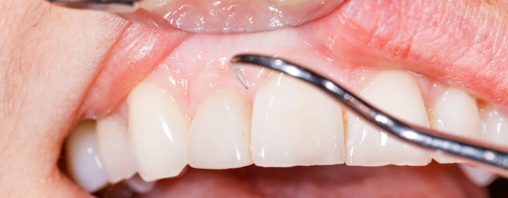 what-causes-receding-gums-1024x683