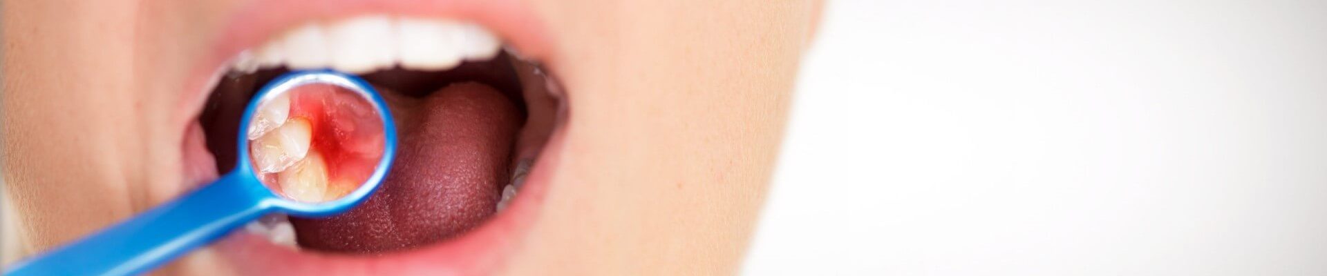 what-does-gingivitis-look-like-scaled-minified