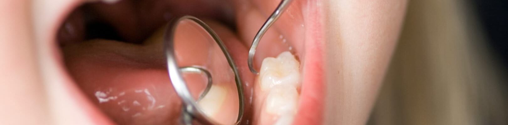 when-do-molars-come-in-scaled-minified