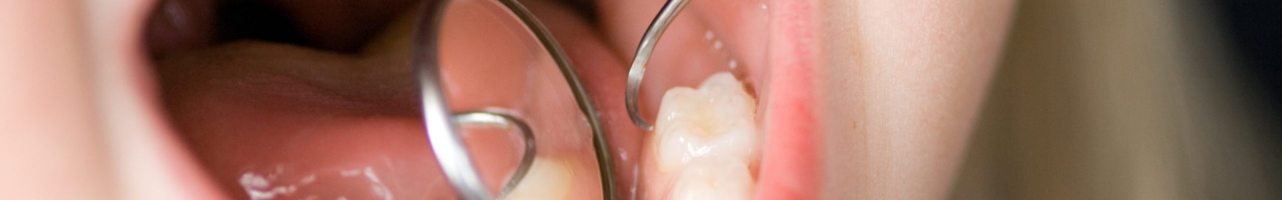 Most kids start getting their permanent teeth around the age of six, and this includes the molars. Here’s what parents need to know about when molars come in and what they can do to help their children get through the process.